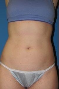 Stephen Bresnick, MD liposuction after — Los Angeles, CA