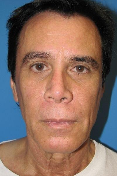 Facelift before at Stephen Bresnick, MD in Los Angeles, CA