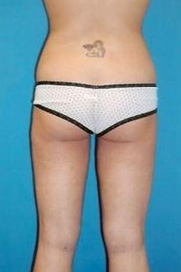 Stephen Bresnick, MD liposuction after — Los Angeles, CA