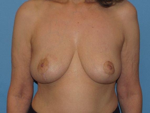 Breast Reduction after at Stephen Bresnick, MD in Los Angeles, CA