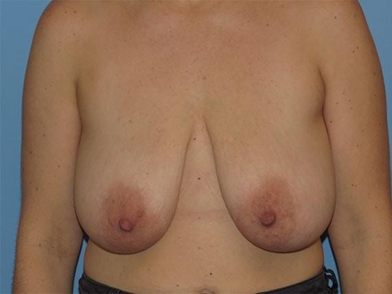 Breast Reduction before at Stephen Bresnick, MD in Los Angeles, CA