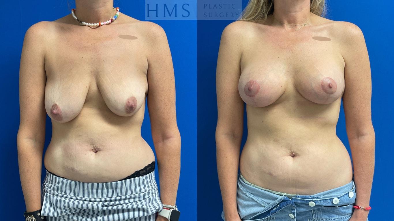HMS Plastic Surgery (Harry M. Salinas, MD) breast lift result — Bay Harbor Islands, FL
