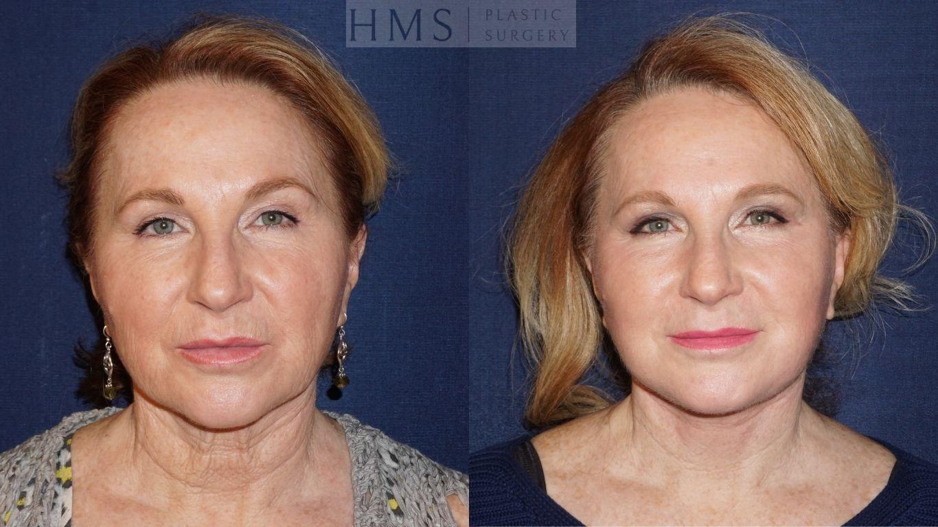 HMS Plastic Surgery (Harry M. Salinas, MD) facelift result — Bay Harbor Islands, FL