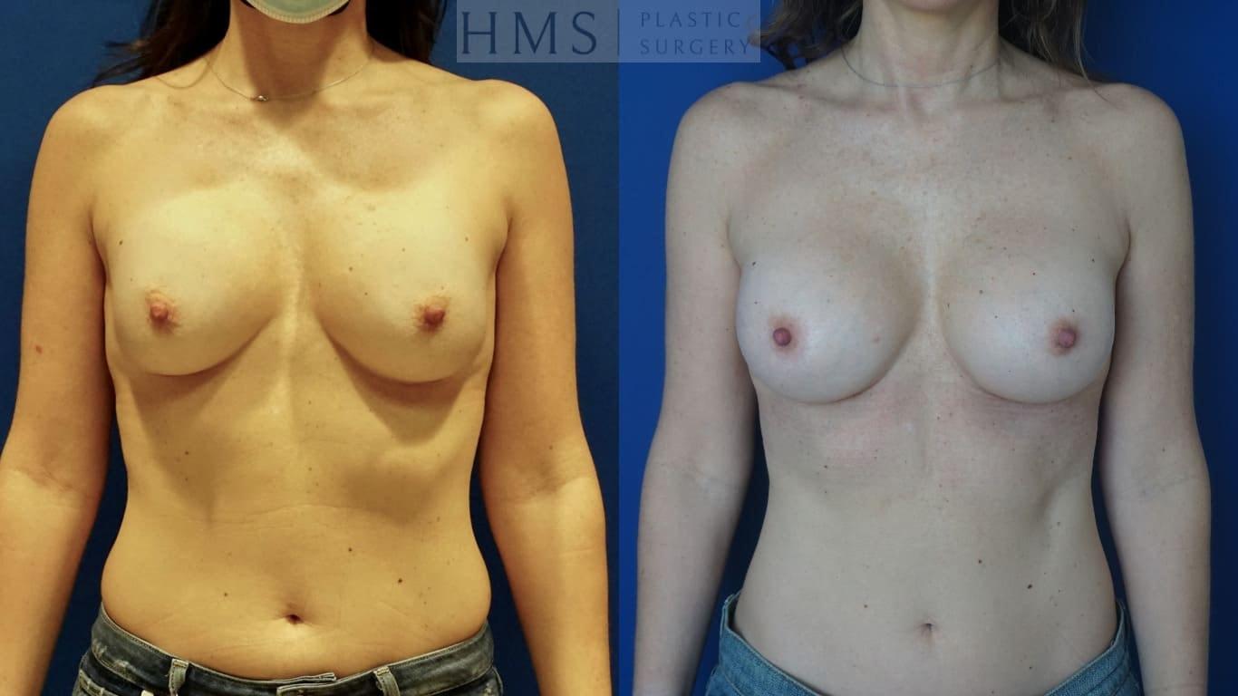 HMS Plastic Surgery (Harry M. Salinas, MD) breast augmentation revision result — Bay Harbor Islands, FL