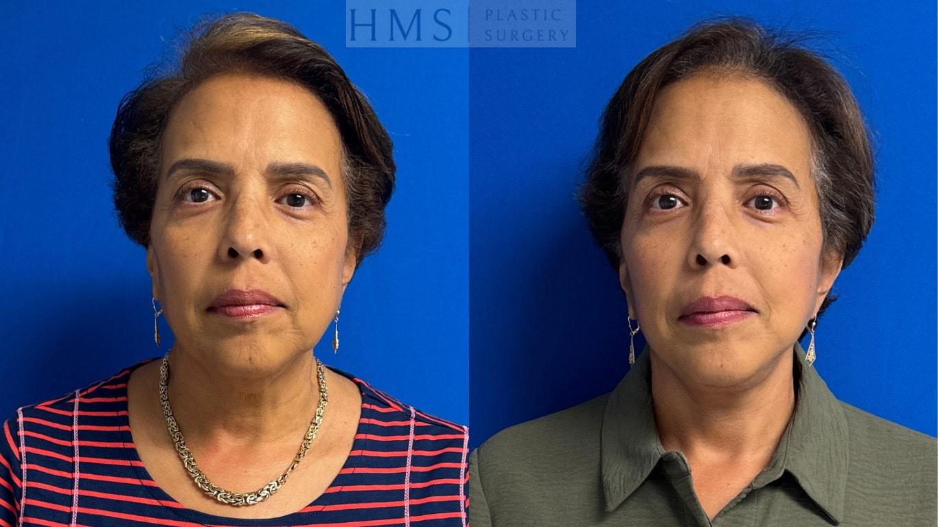 HMS Plastic Surgery (Harry M. Salinas, MD) facelift result — Bay Harbor Islands, FL