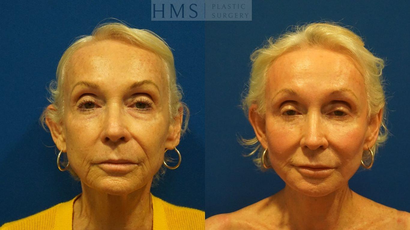 HMS Plastic Surgery (Harry M. Salinas, MD) facelift result — Bay Harbor Islands, FL