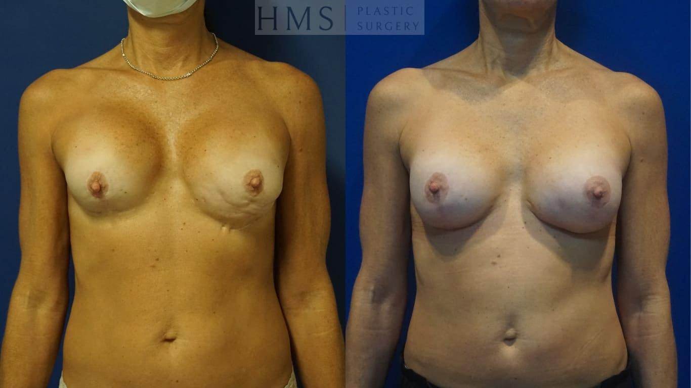 HMS Plastic Surgery (Harry M. Salinas, MD) breast augmentation revision result — Bay Harbor Islands, FL