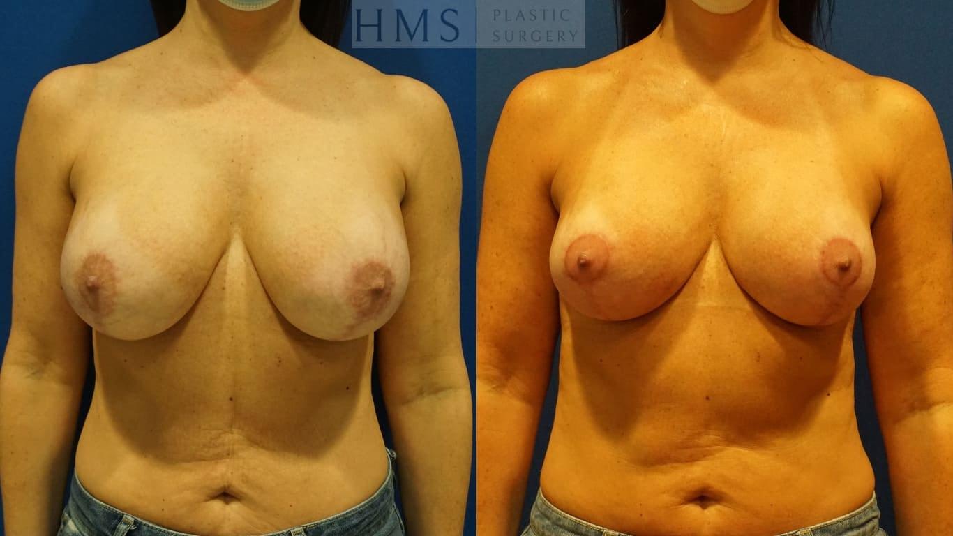 HMS Plastic Surgery (Harry M. Salinas, MD) breast augmentation revision result — Bay Harbor Islands, FL