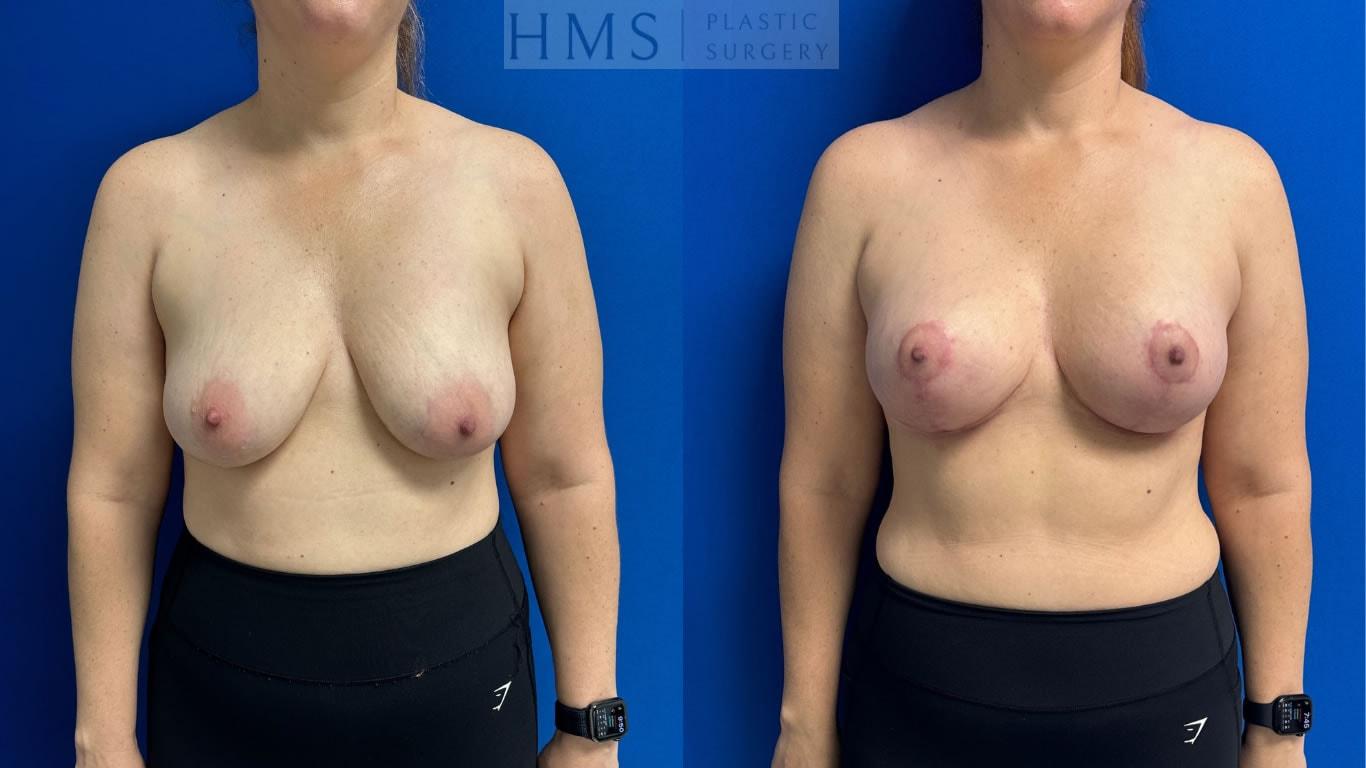 HMS Plastic Surgery (Harry M. Salinas, MD) breast lift result — Bay Harbor Islands, FL