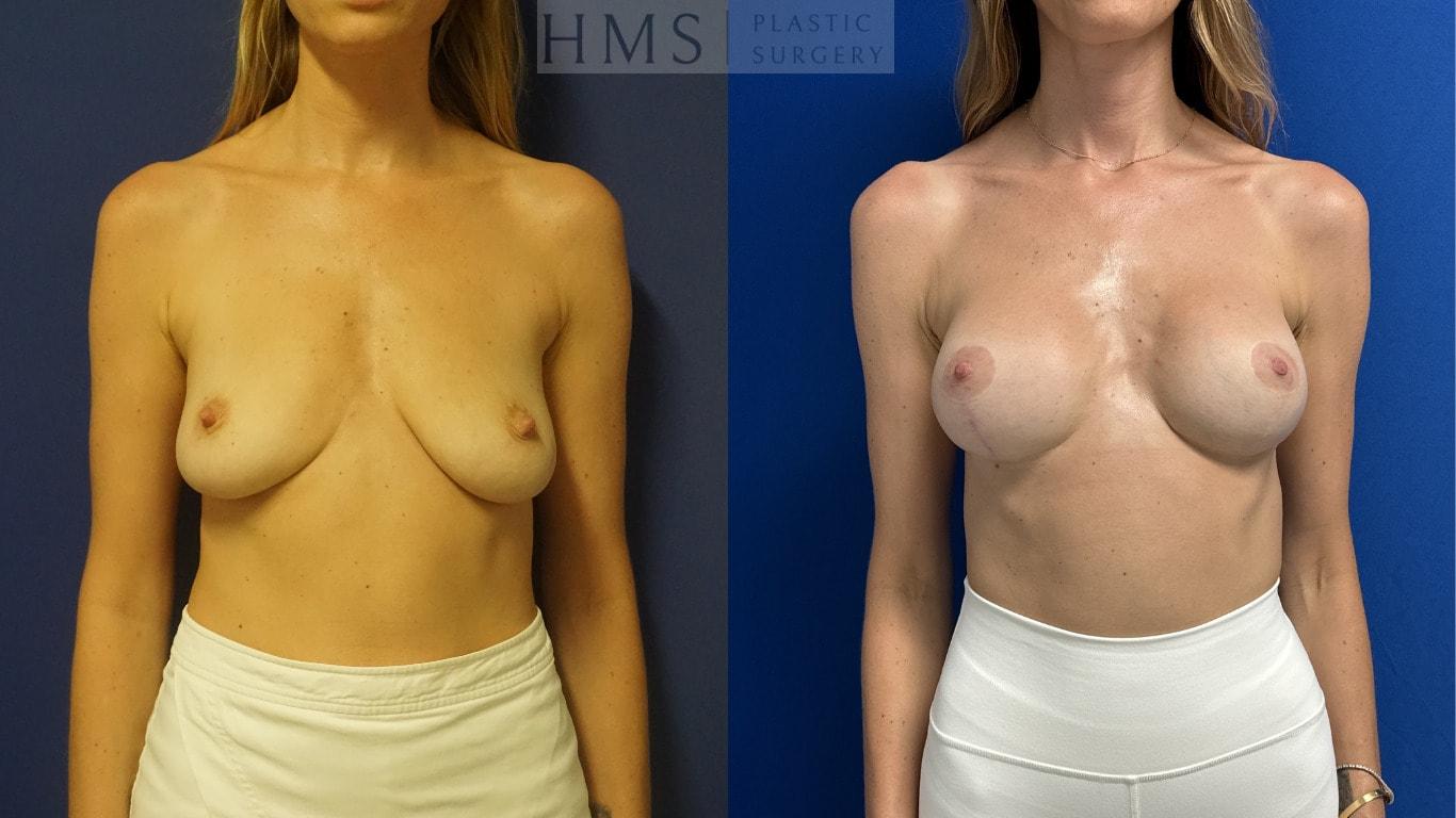 HMS Plastic Surgery (Harry M. Salinas, MD) breast lift result — Bay Harbor Islands, FL