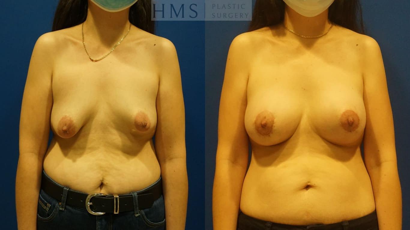 HMS Plastic Surgery (Harry M. Salinas, MD) breast lift result — Bay Harbor Islands, FL