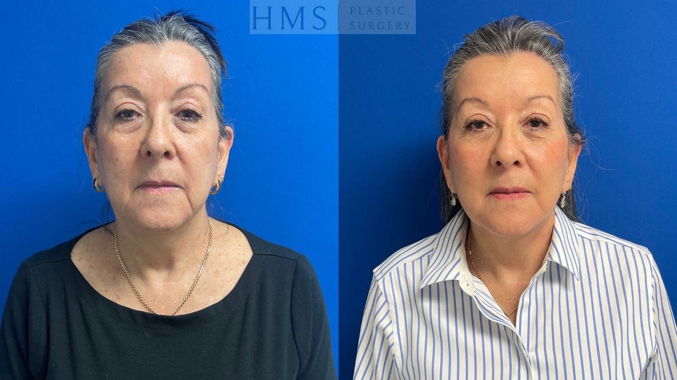 HMS Plastic Surgery (Harry M. Salinas, MD) facelift result — Bay Harbor Islands, FL