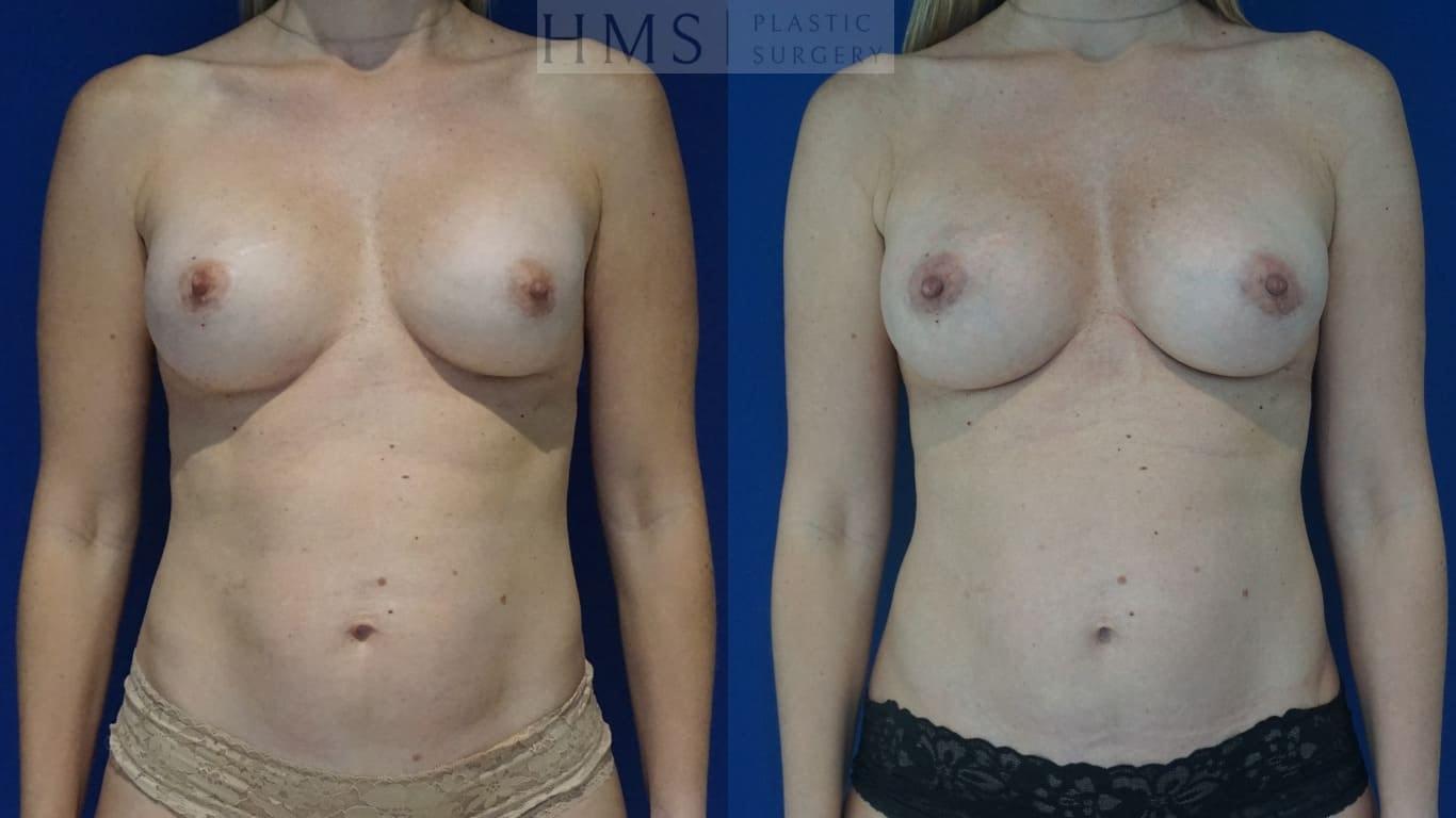 HMS Plastic Surgery (Harry M. Salinas, MD) breast augmentation revision result — Bay Harbor Islands, FL