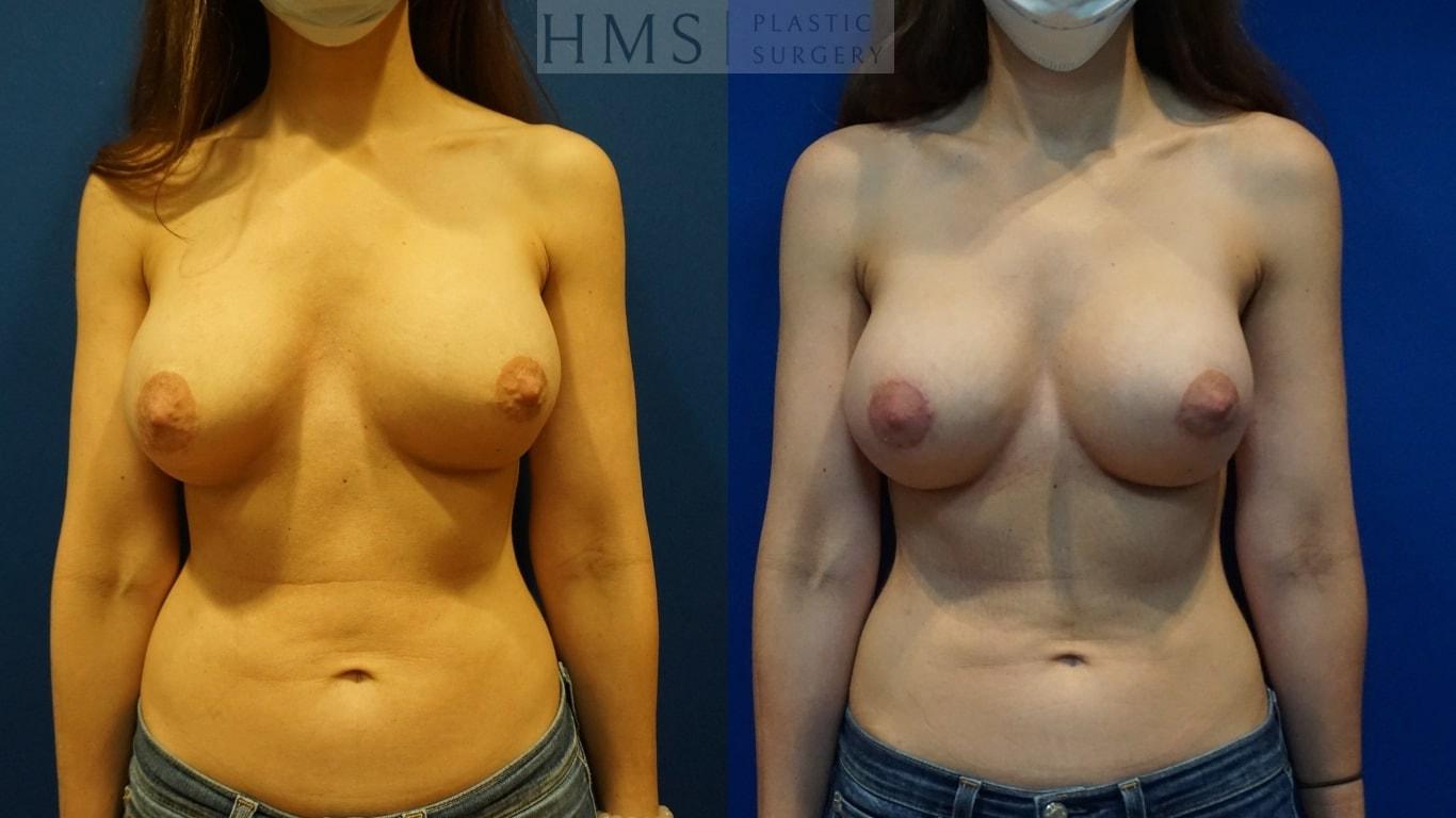HMS Plastic Surgery (Harry M. Salinas, MD) breast augmentation revision result — Bay Harbor Islands, FL
