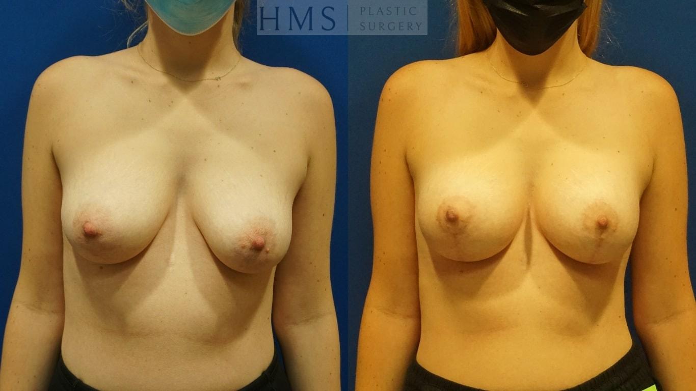 HMS Plastic Surgery (Harry M. Salinas, MD) breast lift result — Bay Harbor Islands, FL