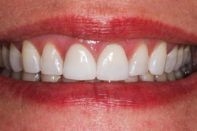 Vero Dental veneers after — Lakewood, CO