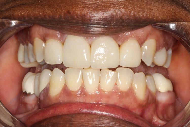 Vero Dental veneers after — Lakewood, CO