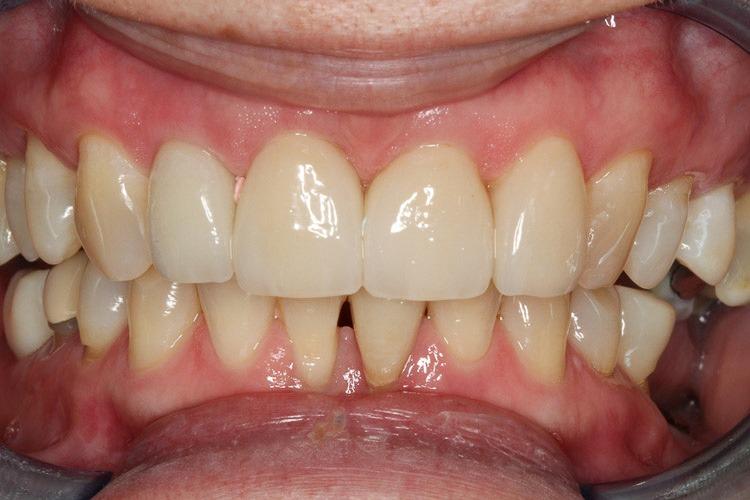 Vero Dental veneers after — Lakewood, CO