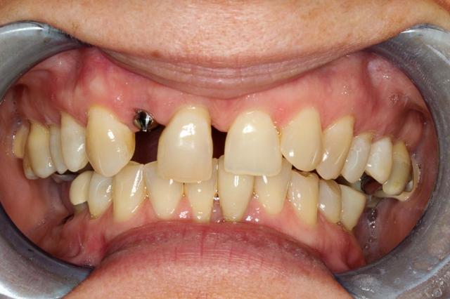 Invisalign before at Vero Dental in Lakewood, CO