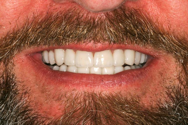 Vero Dental veneers after — Lakewood, CO