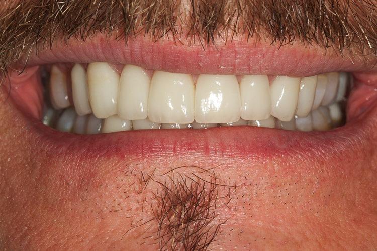 Vero Dental veneers after — Lakewood, CO