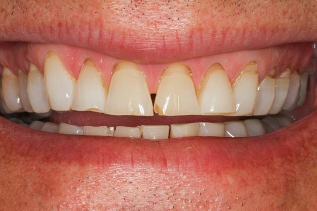 Invisalign before at Vero Dental in Lakewood, CO