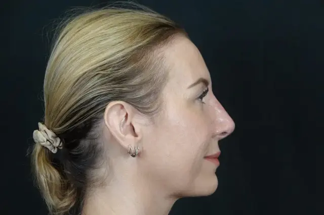 Functional Rhinoplasty after at Mira Aesthetic Cosmetic Surgery Center - Dr. Mirrafati in Costa Mesa, CA