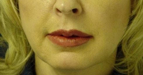Lip Filler after at Mira Aesthetic Cosmetic Surgery Center - Dr. Mirrafati in Costa Mesa, CA