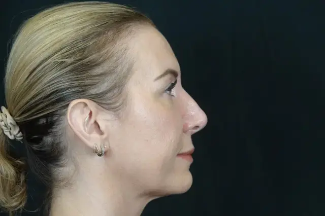 Functional Rhinoplasty before at Mira Aesthetic Cosmetic Surgery Center - Dr. Mirrafati in Costa Mesa, CA