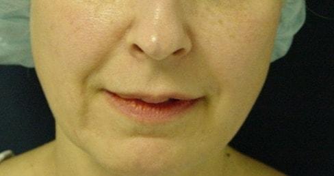 Lip Filler before at Mira Aesthetic Cosmetic Surgery Center - Dr. Mirrafati in Costa Mesa, CA