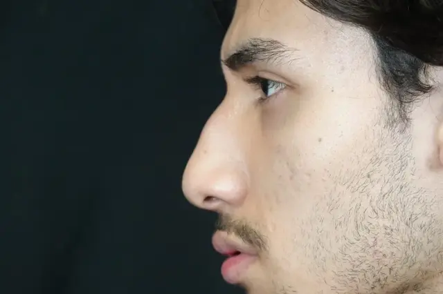 Functional Rhinoplasty before at Mira Aesthetic Cosmetic Surgery Center - Dr. Mirrafati in Costa Mesa, CA