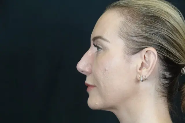 Functional Rhinoplasty before at Mira Aesthetic Cosmetic Surgery Center - Dr. Mirrafati in Costa Mesa, CA