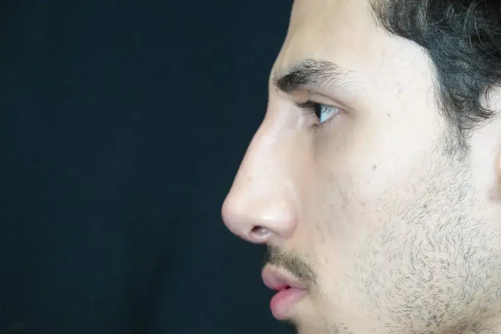 Mira Aesthetic Cosmetic Surgery Center - Dr. Mirrafati rhinoplasty after — Costa Mesa, CA