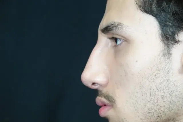 Functional Rhinoplasty after at Mira Aesthetic Cosmetic Surgery Center - Dr. Mirrafati in Costa Mesa, CA