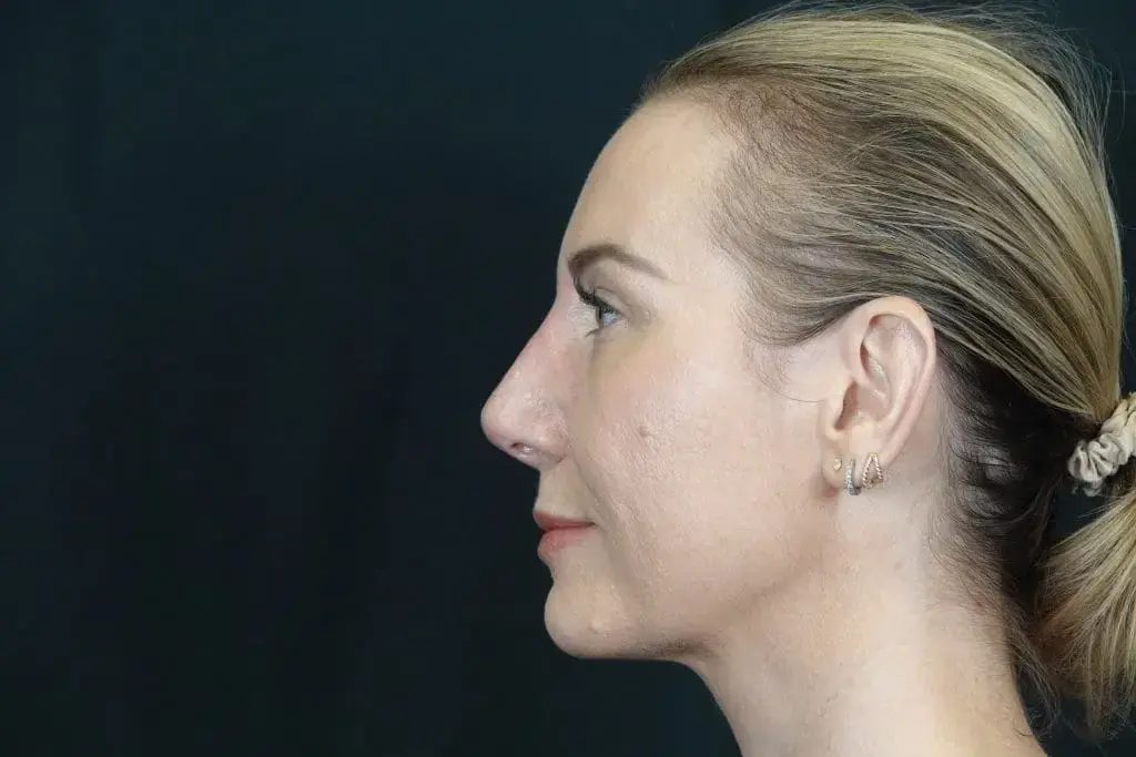 Mira Aesthetic Cosmetic Surgery Center - Dr. Mirrafati rhinoplasty after — Costa Mesa, CA