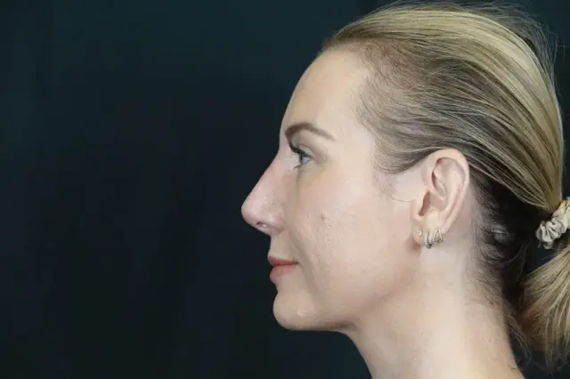 Functional Rhinoplasty after at Mira Aesthetic Cosmetic Surgery Center - Dr. Mirrafati in Costa Mesa, CA