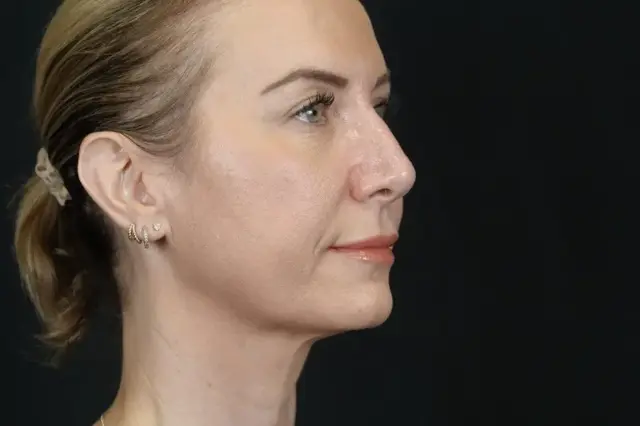 Functional Rhinoplasty before at Mira Aesthetic Cosmetic Surgery Center - Dr. Mirrafati in Costa Mesa, CA