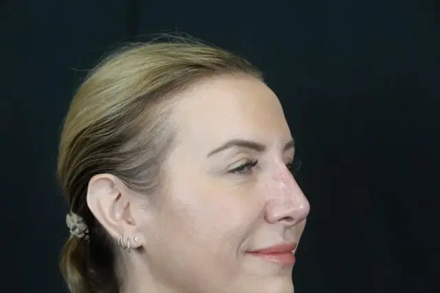 Functional Rhinoplasty after at Mira Aesthetic Cosmetic Surgery Center - Dr. Mirrafati in Costa Mesa, CA