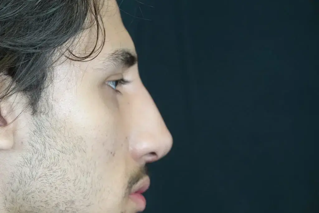Mira Aesthetic Cosmetic Surgery Center - Dr. Mirrafati rhinoplasty after — Costa Mesa, CA