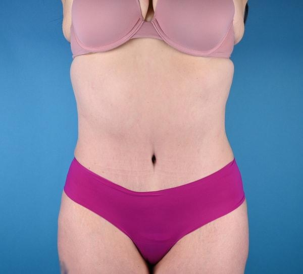 Plastic Surgery Clinic of Chicago tummy tuck after — Chicago, IL