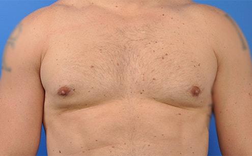 Plastic Surgery Clinic of Chicago gynecomastia after — Chicago, IL