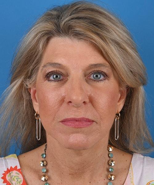 Plastic Surgery Clinic of Chicago brow lift after — Chicago, IL