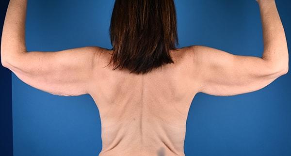 Arm Lift before at Plastic Surgery Clinic of Chicago in Chicago, IL
