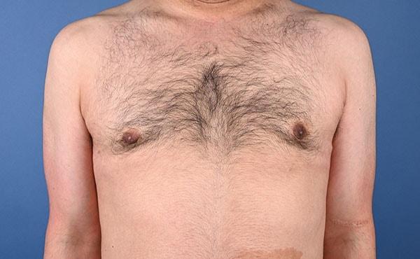 Plastic Surgery Clinic of Chicago gynecomastia after — Chicago, IL