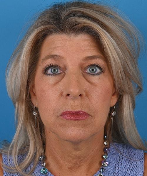Brow Lift before at Plastic Surgery Clinic of Chicago in Chicago, IL