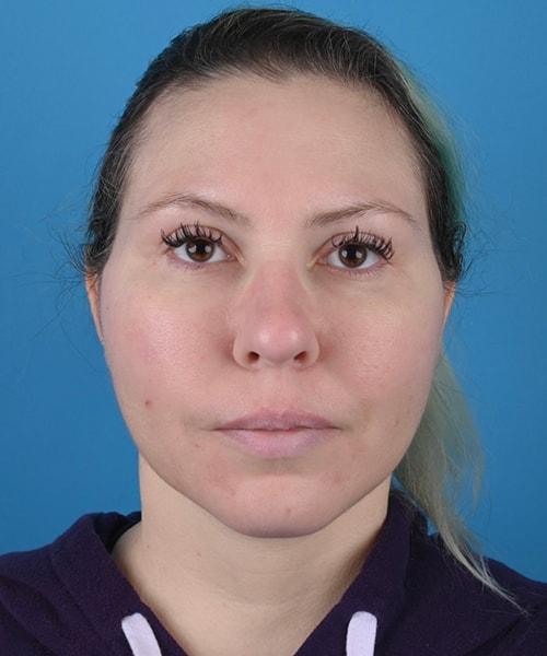 Plastic Surgery Clinic of Chicago facelift after — Chicago, IL