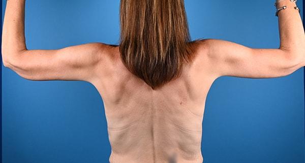 Arm Lift after at Plastic Surgery Clinic of Chicago in Chicago, IL