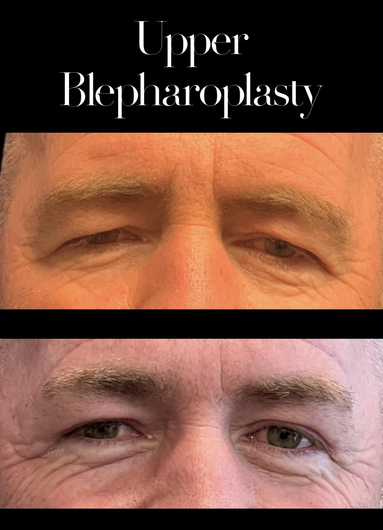 PEAK PLASTIC SURGERY blepharoplasty result — Draper, UT