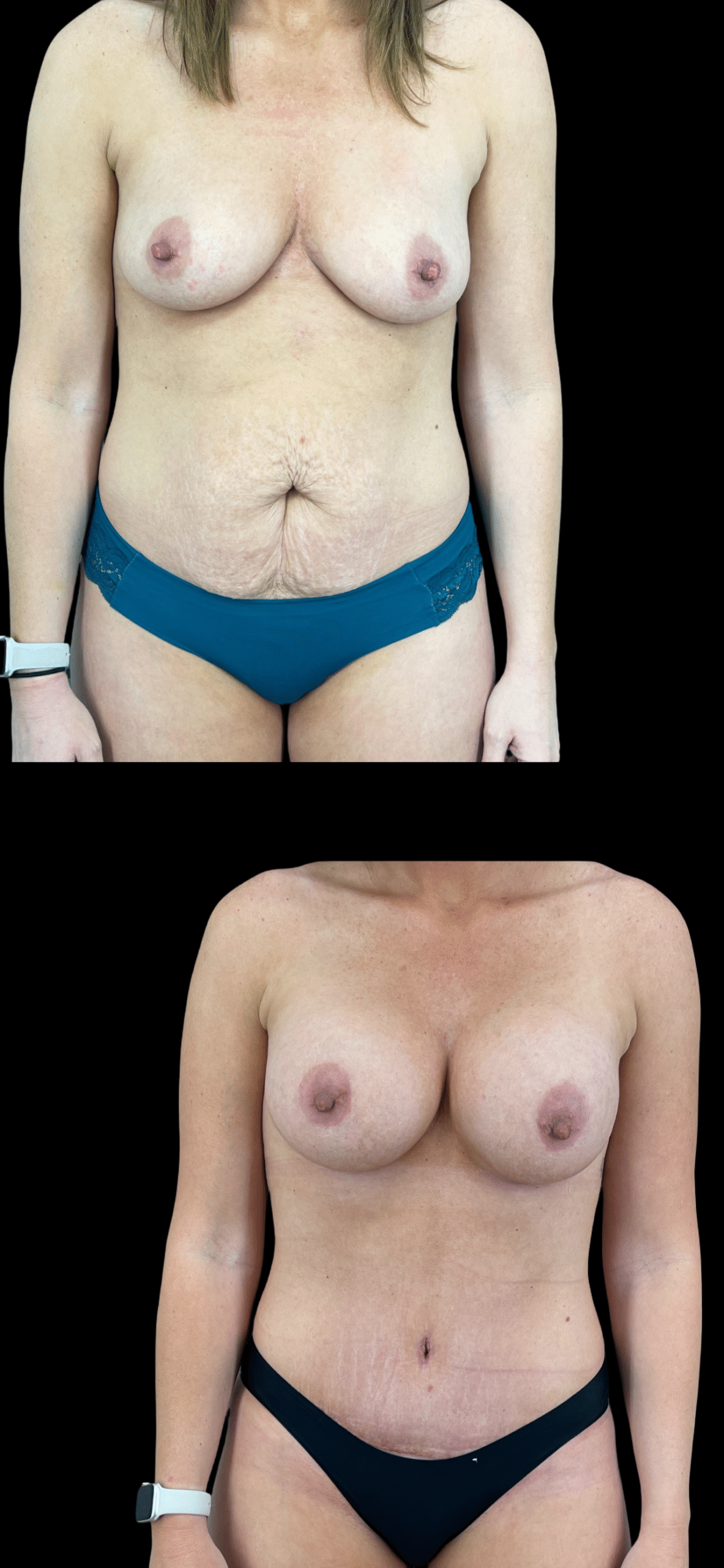 PEAK PLASTIC SURGERY mommy makeover result — Draper, UT