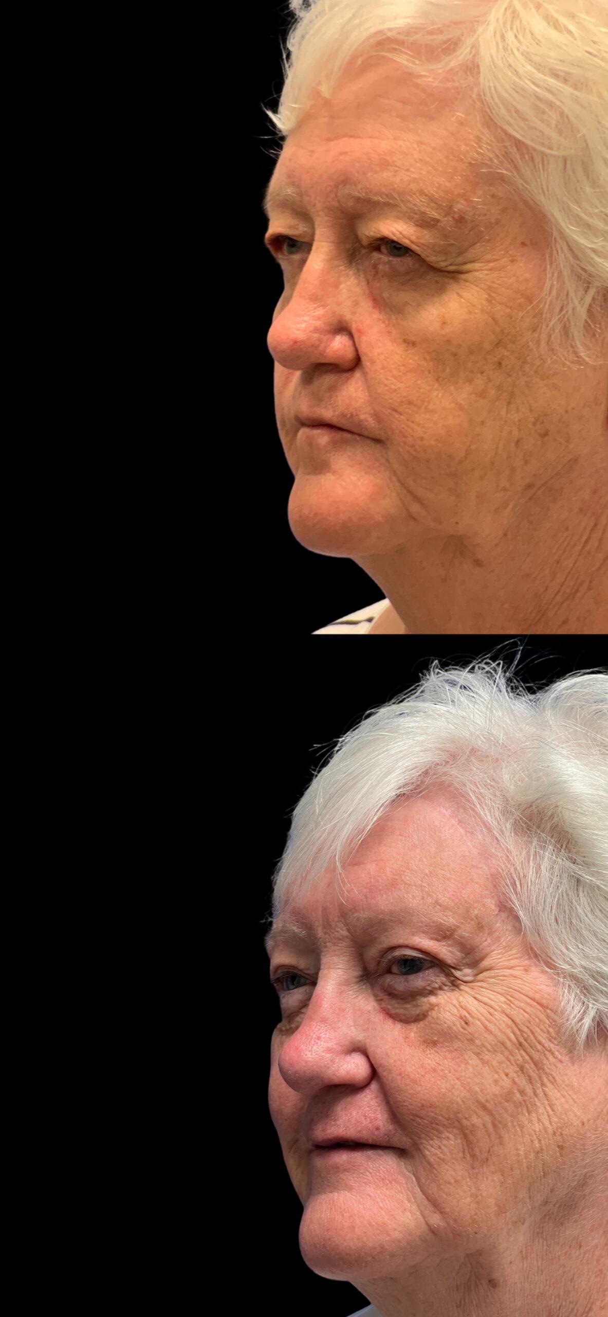 PEAK PLASTIC SURGERY brow lift result — Draper, UT